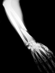 Broken bone x ray